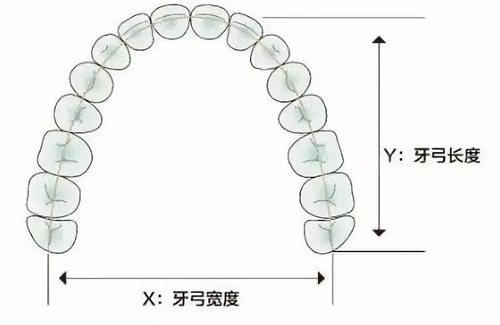 牙齿矫正扩牙弓示意图.jpg