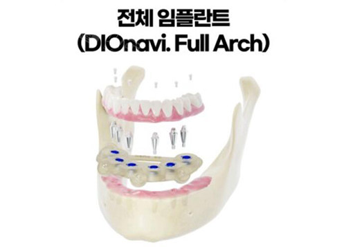 韩国dio种植体半口种植牙.jpg