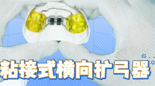 粘接式扩弓器怎么样.jpg