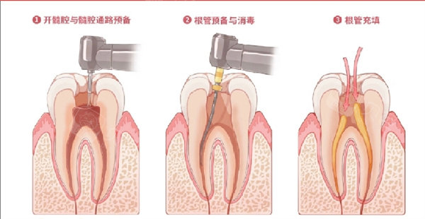 根管治疗展示.jpg