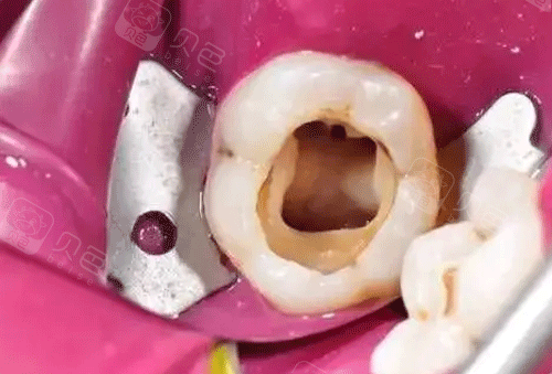 牙齿根管治疗图片.png
