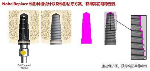 诺贝尔种植牙 (2).jpg
