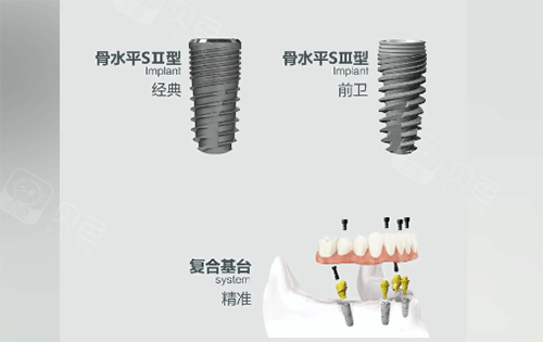 安联种植牙用起来怎么样.png