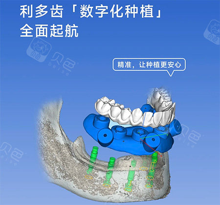 利多齿种植牙怎么样.jpg