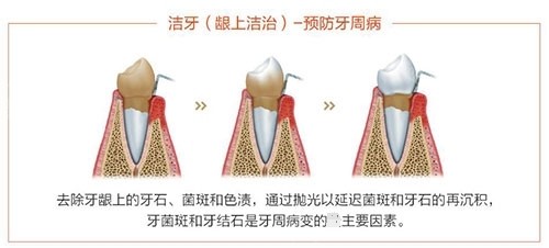 洗牙龈上洁治过程示意图.jpg