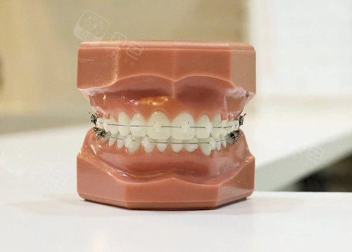 牙齿矫正陶瓷托槽牙套模型.jpg