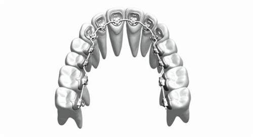 牙齿矫正舌侧矫正牙套概念透视图.jpg