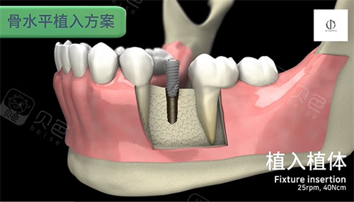 韩一种植体怎么样.jpg