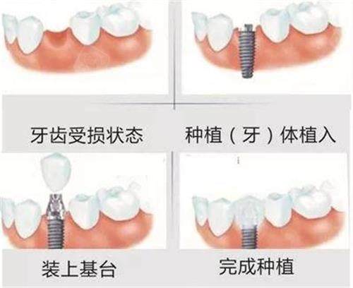 江苏扬州邗江仪征金铂利口腔医生介绍：曾强主攻all-on-6/胡冬阳擅长高难度拔智齿，技术分工清晰