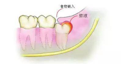 娄底景辰口腔冠周炎冲洗加上药150元：快速降低炎症止痛，特色处理阻生齿冠周炎症