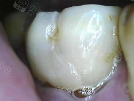 娄底景辰口腔牙周治疗全口1500元起：分度科学诊理，有效遏制牙周炎守护牙齿
